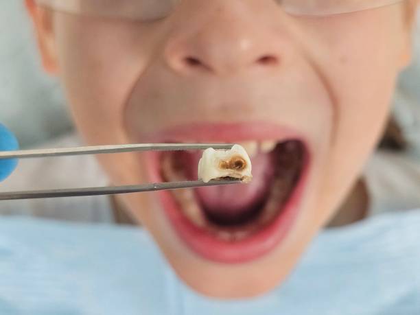 Best Emergency Dental Care for Sports Injuries in Elkhorn City, KY